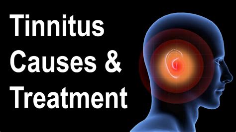 What Is Tinnitus Causes And Treatment Strategies Youtube