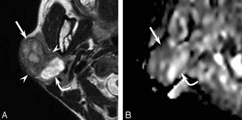 Carcinoma Ex Pleomorphic Adenoma Of The Parotid Gland Radiologic