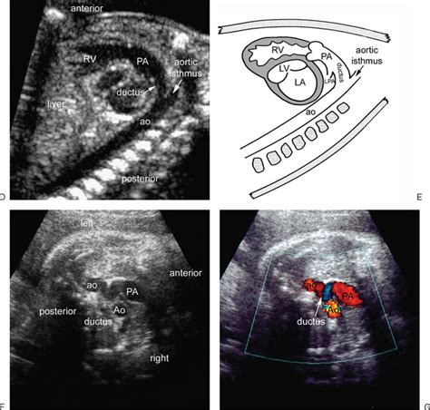 Ultrasound Evaluation Of The Fetal Heart Radiology Key