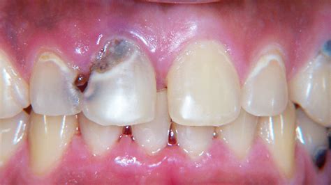 Case Study In Tooth Decay In Ballwin And Manchester Mo Dentistry