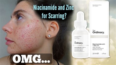 I Tested The Ordinary Niacinamide And Zinc Serum For My Acne Scars One