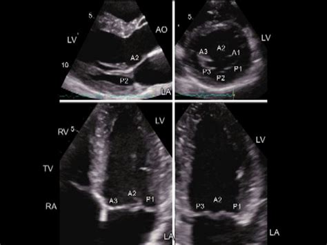 Mitral Valve Echocardiography