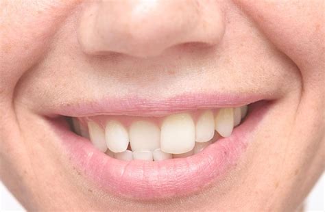 Common Causes Of And Treatment For Crooked Teeth Dunn Ortho