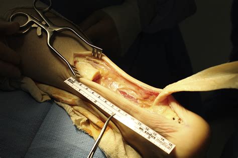 Debridement with tendon transfer — for tendons with more than 50% damage, tendon from the big toe is transferred to the achilles if it is small tear it might heal by itself and not require surgery; Combined Tendon and Bone Allograft Transplantation for ...