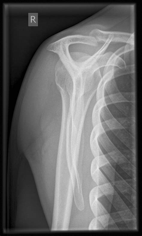 Shoulder X Ray Interpretation Wikem