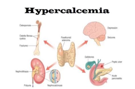 Hypercalcemia