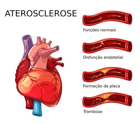 O Que Aterosclerose Fisiopatologia E Causas Arteriosclerose The Best