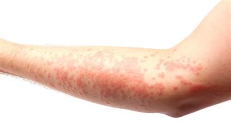 Allergy Skin Rash Dorothee Padraig South West Skin