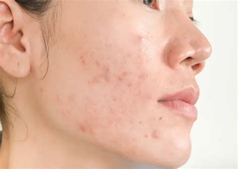 What Causes Acne Scars And How To Prevent Acne Scars Schweiger