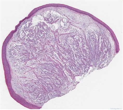 Vocal Cord Polyp Atlas Of Pathology