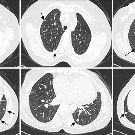Chest Ct Bilateral Multiple Nodules The Largest Of Them Is Hilar And