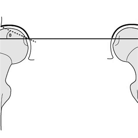 Acetabular Index A Line Is Drawn Between The Points That Represent The