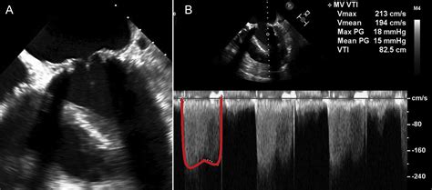 A Case Of Bioprosthetic Mitral Valve Dysfunction Initially Presenting
