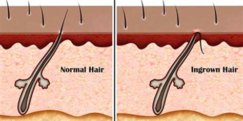 Ingrown Hair On Headscalp Causes Symptoms Treatment