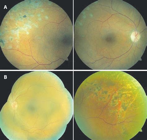 Scielo Brasil Case Report Pneumatic Retinopexy For The Treatment