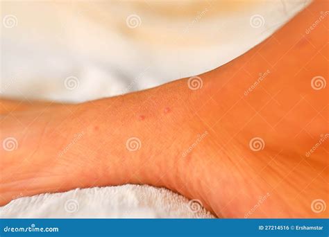 Bed Bug Bites Feet
