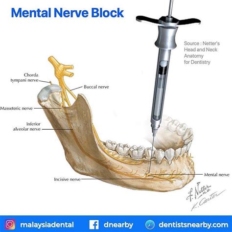 Long Buccal Nerve Block Julienabbrojas