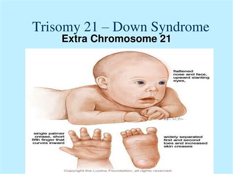 Ppt And Genetic Disorders Powerpoint Presentation Free Download Id4678890