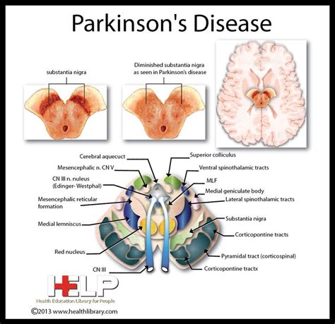 How Does Parkinsons Affect The Nervous System