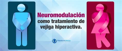 Neuromodulación Como Tratamiento De Vejiga Hiperactiva Dispositivos Médicos