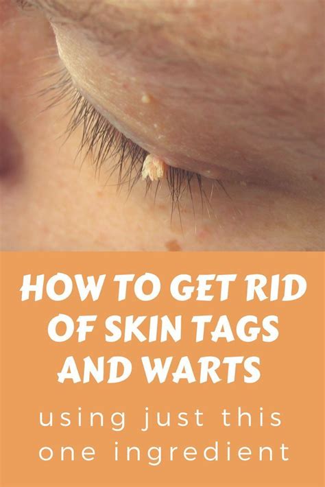 how to naturally get rid of skin tags on eyelids howotremvo