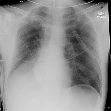 Right Lower Lobe Collapse Pacs