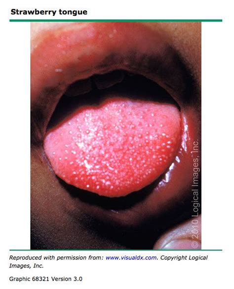1000 Images About Strep Throat Provider Info On Pinterest Scarlet