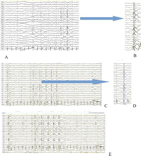 Rolandic Epilepsy Self Limited Epilepsy With Centrotemporal Spikes