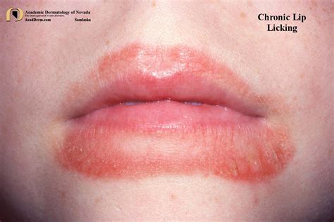 Chronic Lip Licking Exfoliative Cheilitis Academic Dermatology Of