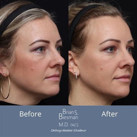 Injectable Fillers Before And After Brian S Biesman Md