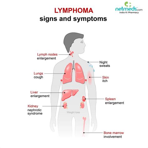 Lymphoma Causes Symptoms And Treatment Netmeds