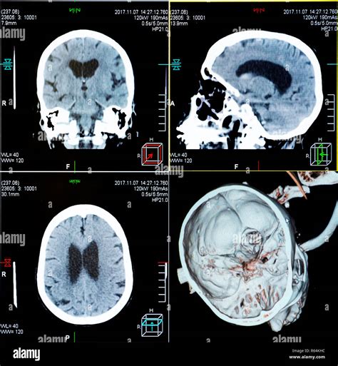 Ct Scan Head Injury Stock Photos And Ct Scan Head Injury Stock Images Alamy