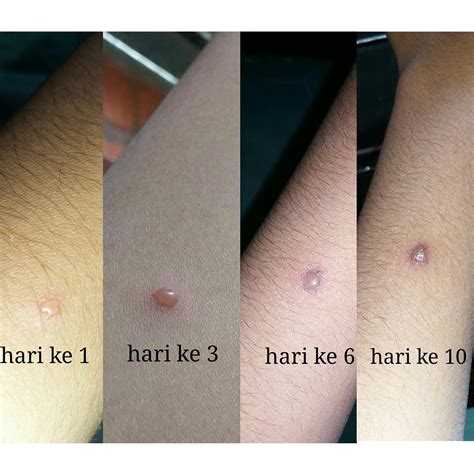 Agar Cacar Air Cepat Sembuh - Info Kesehatan