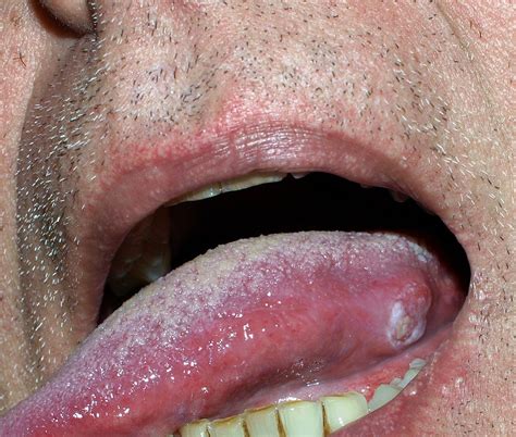 Mouth Cancer Bumps Under Tongue F21
