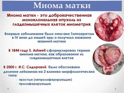 Заболевания тела матки: миома и саркома - презентация онлайн Картинка - Заболевания тела матки: миома и саркома - презентация онлайн