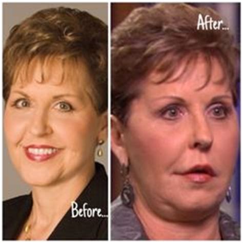 Celebrity Face Lift Before And After Ideas Celebrity Faces Plastic Surgery Facelift