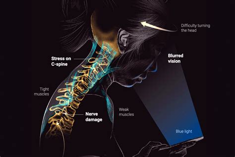 Why Your Smartphone Is Causing You ‘text Neck Syndrome — Information