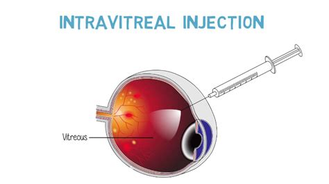 Benefits Of Intravitreal Injections Vitafoodssouthamerica