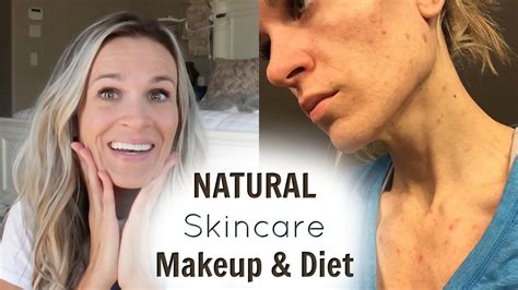 How I Cleared My Acne Skincare Makeup Diet Skin Care Acne Skin Care