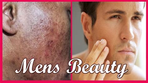 Beauty Tips For Men Remove Dark Spot From Your Face Youtube