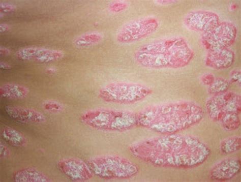 Plaque Psoriasis Dermatology Teachim