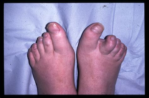 Psoriasis And Psoriatic Arthritis On The Feet