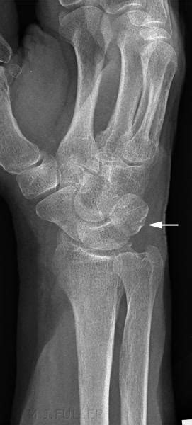 Triquetrum Fracture Hand Orthobullets Persistent Ulnar Sided