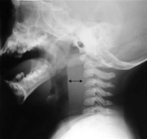 Retropharyngeal Abscess Concise Medical Knowledge