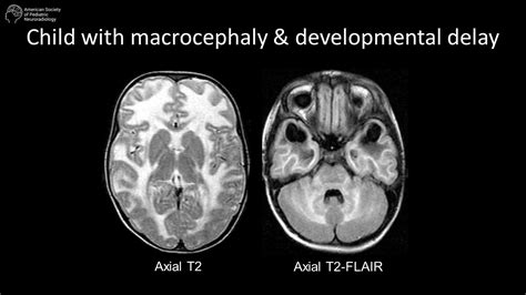 Child With Macrocephaly And Developmental Delay American Society Of