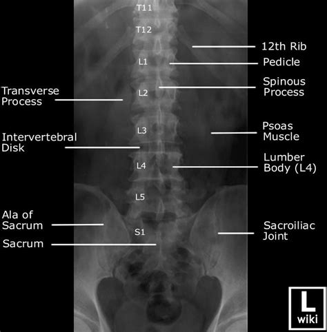 Lumbar Spine Radiographic Anatomy Diagnostic Imaging Medical Anatomy
