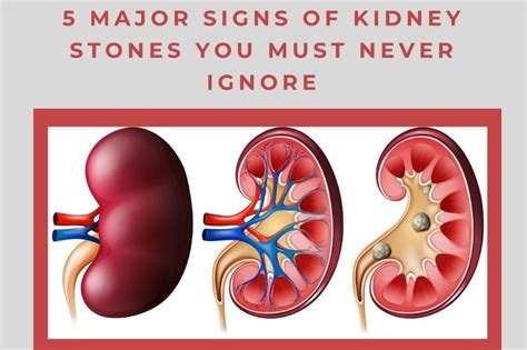 5 Major Signs Of Kidney Stones You Must Never Ignore