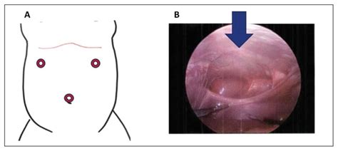 Minimally Invasive Repair Of Pediatric Morgagni Hernias Using Transfascial Sutures With