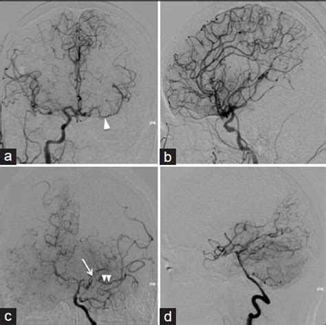 Conventional Angiography Of The Right Internal Carotid Artery A And B