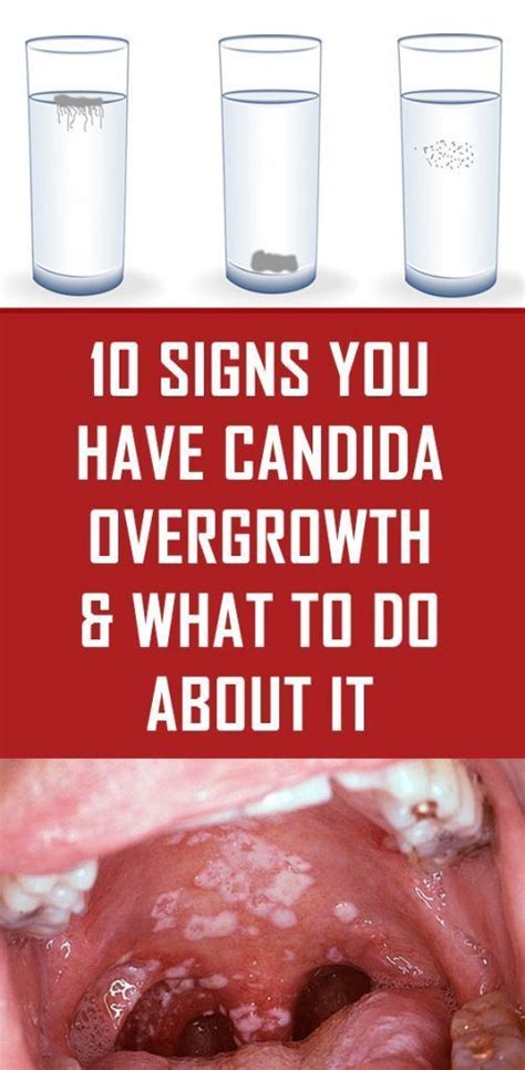 10 Signs You Have Candida Overgrowth And What To Do About It With Images